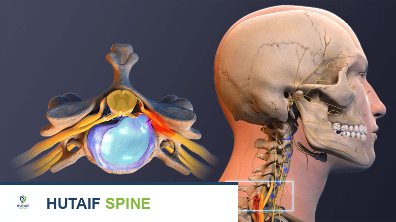 قرار جراحة القرص التنكسي العنقي: متى تكون ضرورية؟