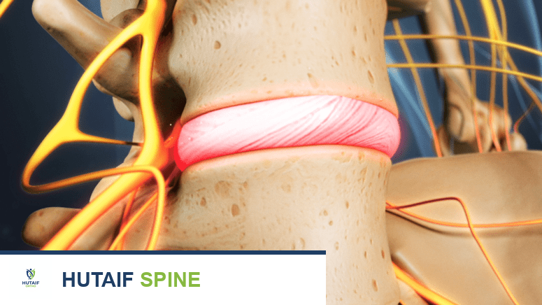 مرض القرص التنكسي: دليلك الشامل للتشخيص والعلاج الفعال مع الأستاذ الدكتور محمد هطيف