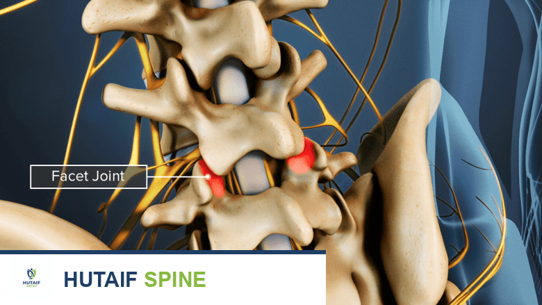 الانزلاق الفقاري التنكسي الأسباب الأعراض والعلاج مع الأستاذ الدكتور محمد هطيف