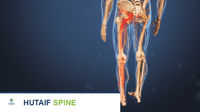 تشخيص عرق النسا: دليل شامل لفهم الأسباب والعلاج مع الأستاذ الدكتور محمد هطيف