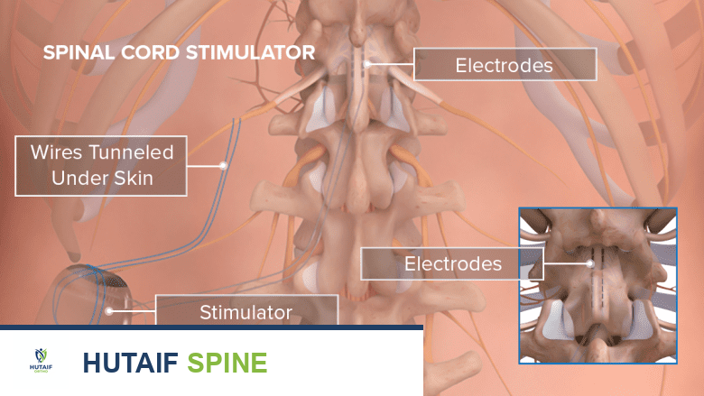 مخاطر ومضاعفات جهاز تحفيز الحبل الشوكي: دليلك الشامل من الأستاذ الدكتور محمد هطيف