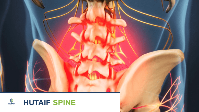 دليلك الشامل لحقن الستيرويد فوق الجافية: تخفيف آلام الظهر وعرق النسا ومعدلات النجاح مع الأستاذ الدكتور محمد هطيف