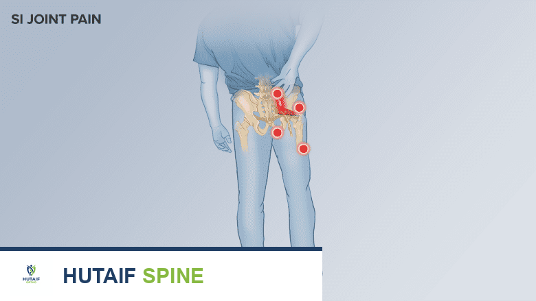 Illustration of the pain pattern and areas affected by pain in SI joint dysfunction.