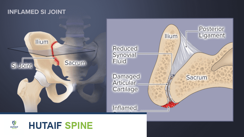 صورة توضيحية لـ التمارين والعلاج الطبيعي لآلام مفصل الحوض العجزي: دليل شامل من الأستاذ الدكتور محمد هطيف
