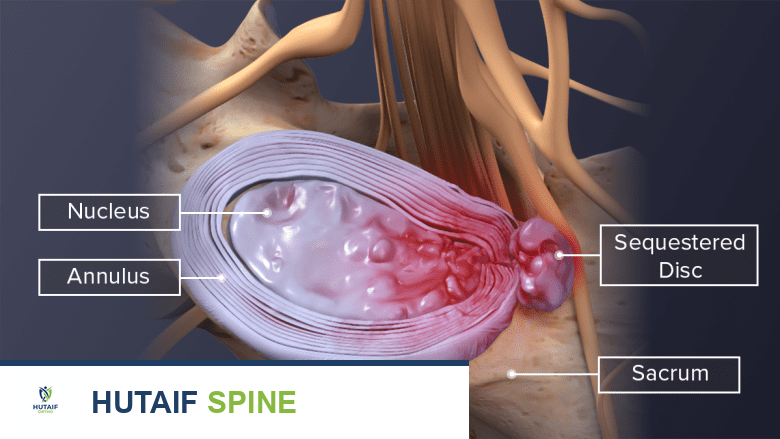 فشل جراحة فك الضغط القطني: الأسباب، الأعراض، والحلول مع الدكتور محمد هطيف