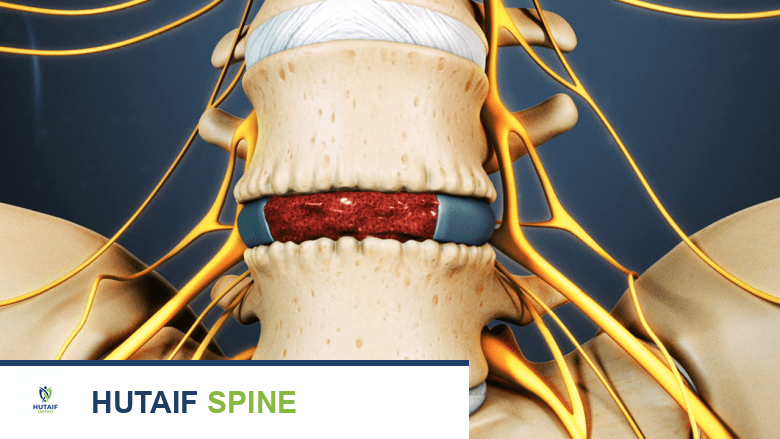فشل عملية دمج الفقرات الأسباب الأعراض وخيارات العلاج المتقدمة في صنعاء