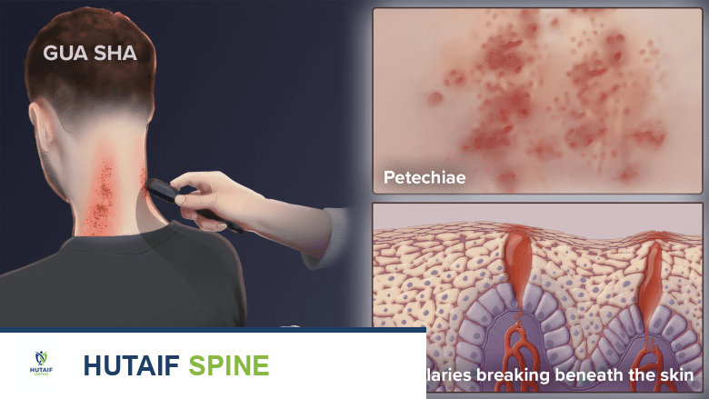 علاج الغوا شا (Gua Sha) لآلام الرقبة المزمنة: دليل شامل من الأستاذ الدكتور محمد هطيف