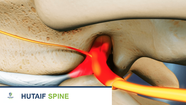 صورة توضيحية لقرص غضروفي منزلق يضغط على عصب بين فقرتين
