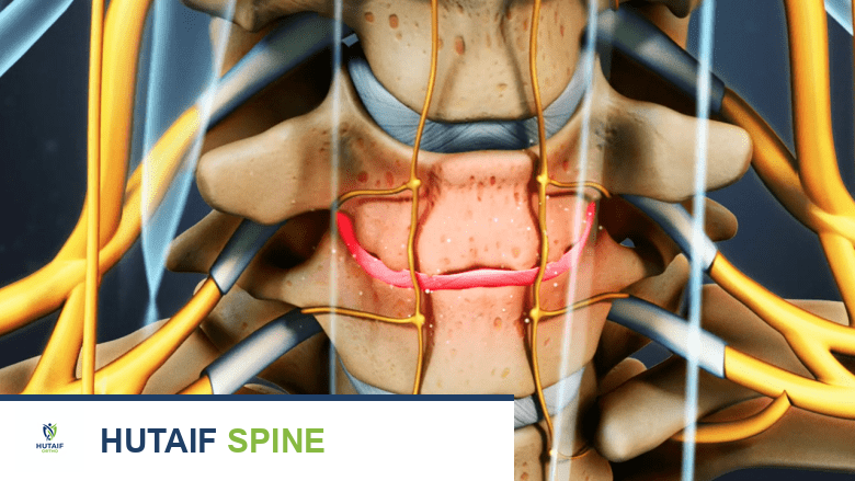 صورة توضيحية تظهر تنكس القرص الرقبي