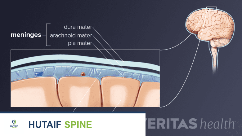 التهاب السحايا وتيبس الرقبة: دليل شامل من الأستاذ الدكتور محمد هطيف في صنعاء