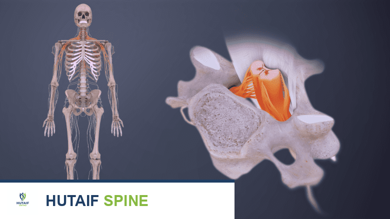 صورة توضيحية لفقرات عنقية متآكلة