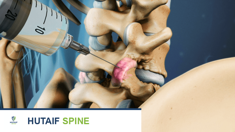 حقن العمود الفقري لتخفيف آلام الرقبة والظهر: دليل شامل من الأستاذ الدكتور محمد هطيف في صنعاء