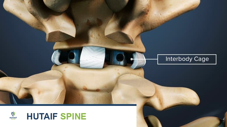 أقفاص دمج الفقرات الحل المتقدم لاستقرار العمود الفقري وعلاج آلام الظهر المزمنة