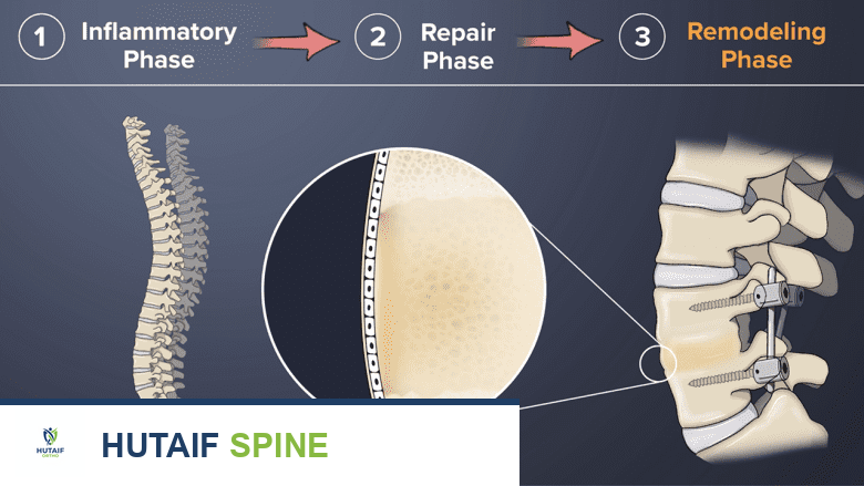 محفز نمو العظام الداخلي لدمج الفقرات: دليل شامل للمرضى مع الأستاذ الدكتور محمد هطيف