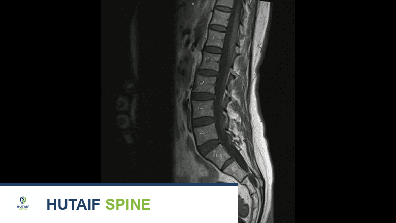 صورة رنين مغناطيسي للعمود الفقري القطني توضح التفاصيل التشريحية.