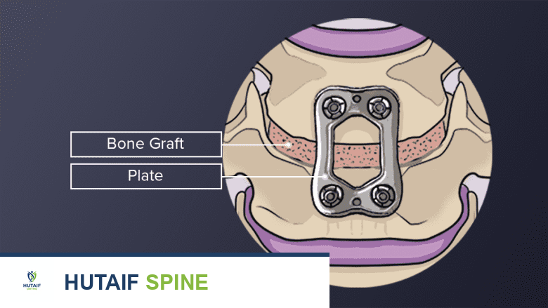 علاج الفقرات L3-L4: دليل شامل لآلام أسفل الظهر مع الأستاذ الدكتور محمد هطيف
