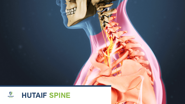 أسباب آلام الرقبة الخفية: دليل شامل من الأستاذ الدكتور محمد هطيف في صنعاء