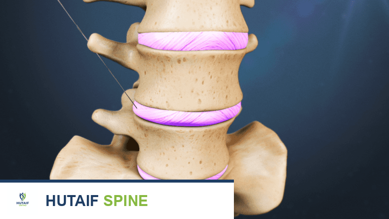 تصوير الأقراص القطنية: دليلك الشامل لتشخيص آلام الظهر وعرق النسا مع الأستاذ الدكتور محمد هطيف في صنعاء