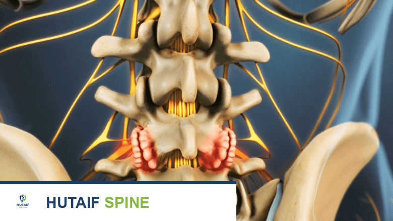 تضيق القناة الشوكية القطنية الأسباب التشخيص والعلاج مع الأستاذ الدكتور محمد هطيف