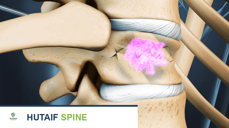 جراحة أورام العمود الفقري المنتشرة: دليل شامل للمرضى مع الأستاذ الدكتور محمد هطيف