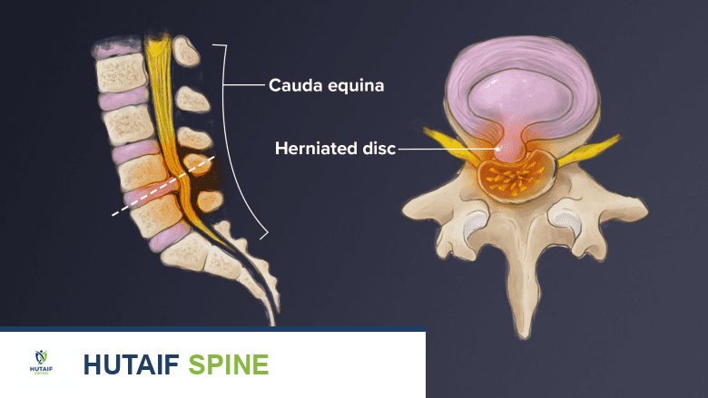 فحص الرنين المغناطيسي للعمود الفقري: دليل شامل للتشخيص الدقيق والعلاج الفعال مع الأستاذ الدكتور محمد هطيف