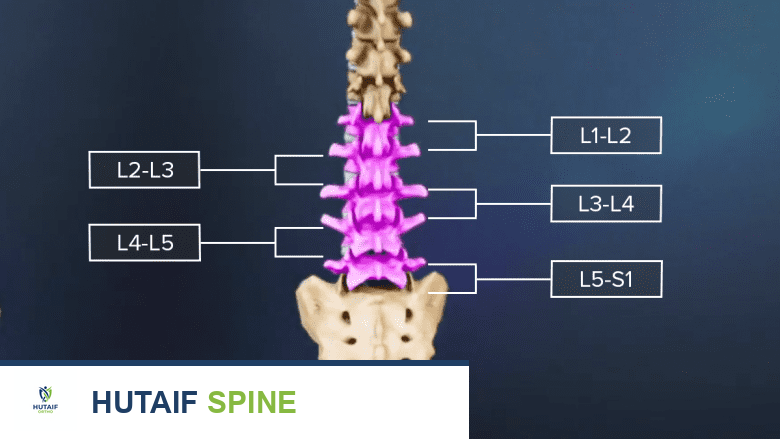منظر خلفي للعمود الفقري من L1 إلى S1 يوضح مستويات الدمج