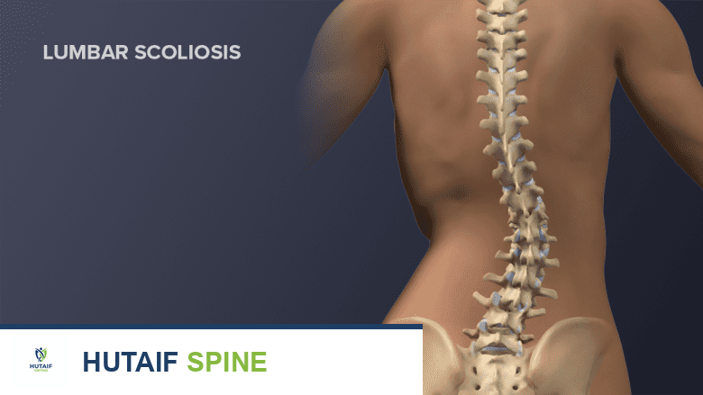 رسم توضيحي لعمود فقري بالغ يظهر الجنف