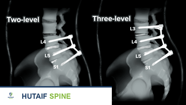 جراحة دمج الفقرات المتعدد المستويات لآلام أسفل الظهر المزمنة