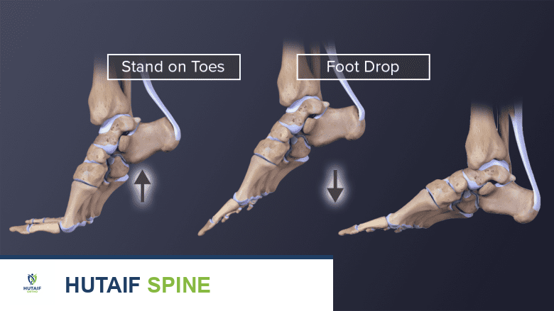 ألم الأعصاب في الساق: دليل شامل للتشخيص والعلاج مع الأستاذ الدكتور محمد هطيف