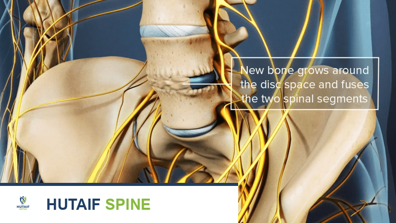 العلاج الكهربائي المتقدم في جراحة العظام: دليل شامل من الأستاذ الدكتور محمد هطيف