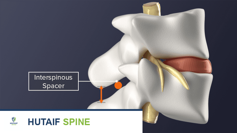 استئصال أو بضع الصفيحة الفقرية القطنية في جراحة اليوم الواحد: حل متقدم لتضيق القناة الشوكية