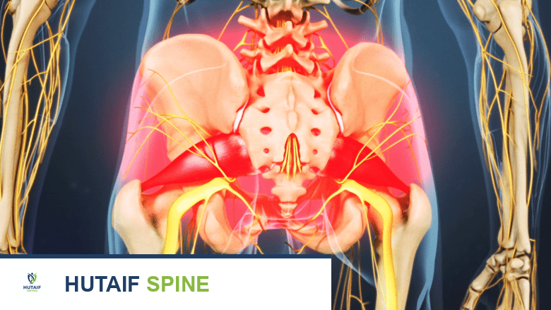 توضيح يظهر آلام أسفل الظهر.