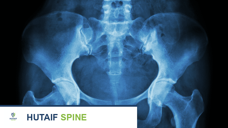 صورة بالأشعة السينية لحوض عظمي