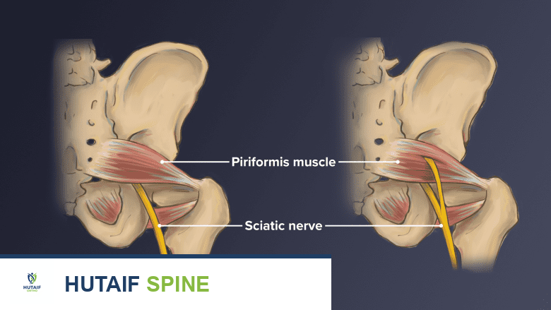 صورة توضيحية لـ جراحة متلازمة الكمثري في صنعاء: دليل شامل مع الأستاذ الدكتور محمد هطيف