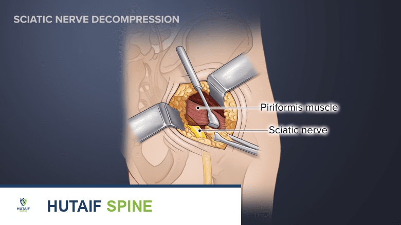 صورة توضيحية لـ جراحة متلازمة الكمثري في صنعاء: دليل شامل مع الأستاذ الدكتور محمد هطيف