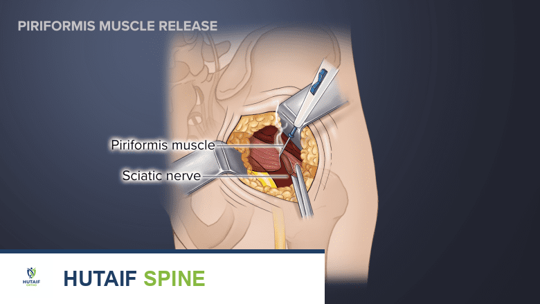 صورة توضيحية لـ جراحة متلازمة الكمثري في صنعاء: دليل شامل مع الأستاذ الدكتور محمد هطيف