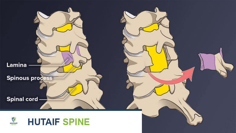 عملية استئصال الصفيحة الفقرية العنقية الخلفية الحل الأمثل لتضيق القناة الشوكية مع الأستاذ الدكتور محمد هطيف