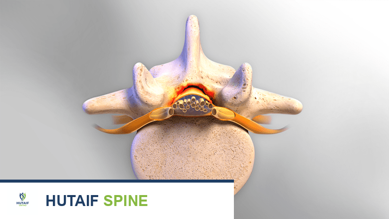 جراحة دمج الفقرات القطنية الخلفي (PLIF): دليل شامل للمرضى مع الأستاذ الدكتور محمد هطيف