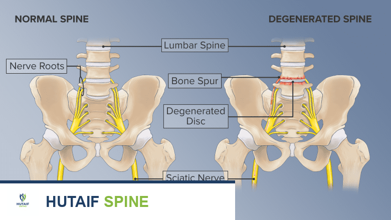 جراحة دمج الفقرات الخلفي الجانبي: دليل شامل للمرضى مع الأستاذ الدكتور محمد هطيف