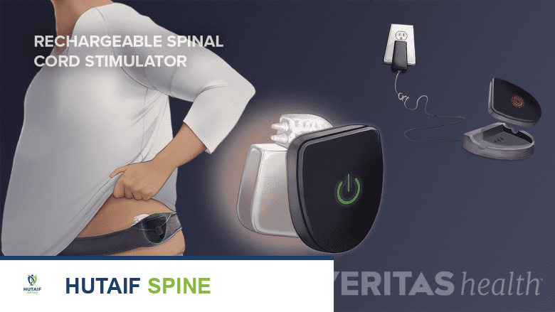 رسم توضيحي طبي لبطارية محفز الحبل الشوكي القابل لإعادة الشحن أثناء الشحن