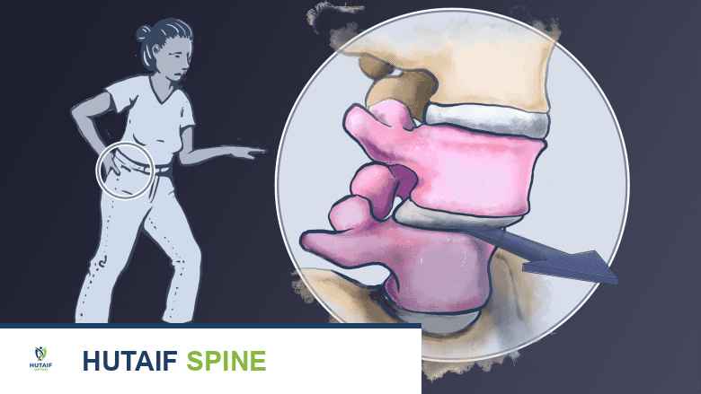 آلام أسفل الظهر للعدائين: متى يجب طلب العلاج؟ دليل شامل من الأستاذ الدكتور محمد هطيف