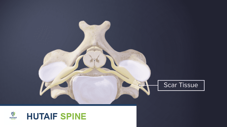 تليف الأنسجة وآلام الظهر بعد الجراحة: دليل شامل للوقاية والعلاج مع الأستاذ الدكتور محمد هطيف