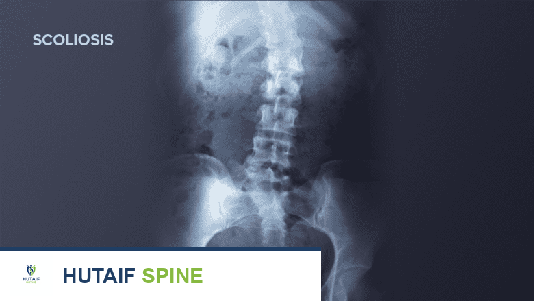 تشخيص الجنف: دليل شامل من الأستاذ الدكتور محمد هطيف