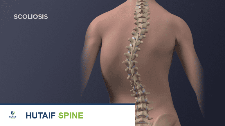 الجنف (اعوجاج العمود الفقري): دليل شامل للمرضى من الأستاذ الدكتور محمد هطيف في صنعاء