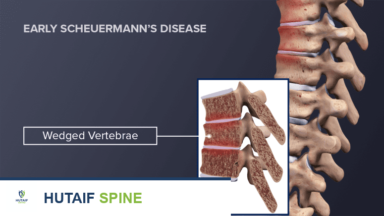 داء شايرمان: دليل شامل لتشوهات العمود الفقري الصدري والقطني وعلاجه مع الأستاذ الدكتور محمد هطيف