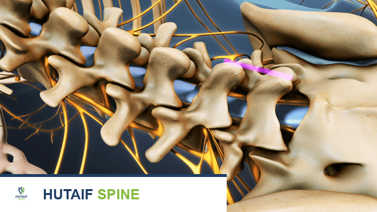 جراحة دمج الفقرات القطنية: دليل شامل للمرضى مع الأستاذ الدكتور محمد هطيف في صنعاء