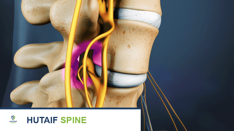 صورة جانبية للعمود الفقري العنقي تظهر ضغطًا على الحبل الشوكي