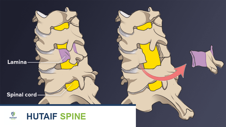 جراحة آلام الرقبة: دليل شامل من الأستاذ الدكتور محمد هطيف في صنعاء