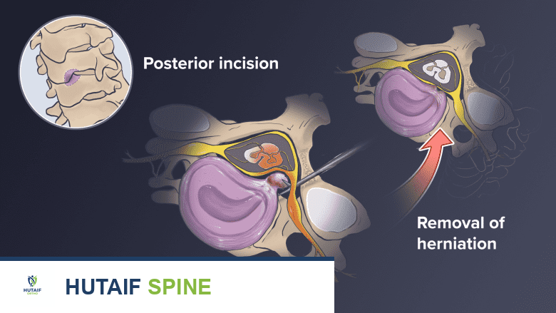 خيارات جراحة الانزلاق الغضروفي العنقي وعرق النسا: دليل شامل من الأستاذ الدكتور محمد هطيف في صنعاء