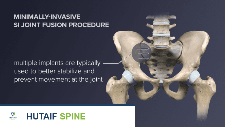 دمج المفصل العجزي الحرقفي: حل جراحي لآلام الظهر المزمنة بخبرة الأستاذ الدكتور محمد هطيف في صنعاء